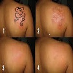 Причини, з яких варто позбутися татуювань